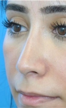 Rhinoplasty After Photo by Ali Totonchi, MD; Cleveland, OH - Case 45573