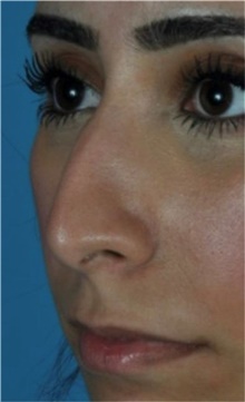Rhinoplasty Before Photo by Ali Totonchi, MD; Cleveland, OH - Case 45573