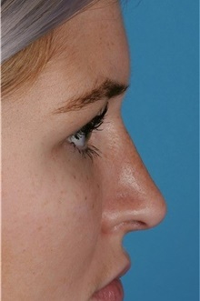 Rhinoplasty After Photo by Ali Totonchi, MD; Cleveland, OH - Case 45574