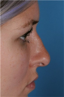 Rhinoplasty Before Photo by Ali Totonchi, MD; Cleveland, OH - Case 45574