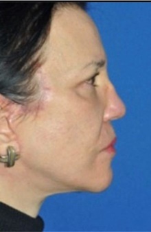 Neck Lift After Photo by Ali Totonchi, MD; Cleveland, OH - Case 45575