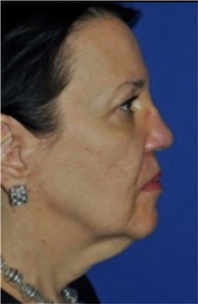 Neck Lift Before Photo by Ali Totonchi, MD; Cleveland, OH - Case 45575
