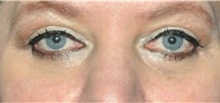 Eyelid Surgery After Photo by Ali Totonchi, MD; Lyndhurst, OH - Case 45581
