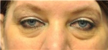 Eyelid Surgery Before Photo by Ali Totonchi, MD; Lyndhurst, OH - Case 45581