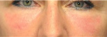 Eyelid Surgery After Photo by Ali Totonchi, MD; Cleveland, OH - Case 45582