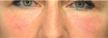 Eyelid Surgery After Photo by Ali Totonchi, MD; Lyndhurst, OH - Case 45582