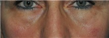 Eyelid Surgery Before Photo by Ali Totonchi, MD; Cleveland, OH - Case 45582