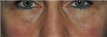 Eyelid Surgery Before Photo by Ali Totonchi, MD; Lyndhurst, OH - Case 45582