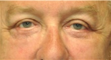 Eyelid Surgery After Photo by Ali Totonchi, MD; Lyndhurst, OH - Case 45585