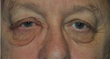 Eyelid Surgery Before Photo by Ali Totonchi, MD; Cleveland, OH - Case 45585