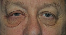 Eyelid Surgery Before Photo by Ali Totonchi, MD; Lyndhurst, OH - Case 45585