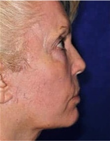Facelift After Photo by Ali Totonchi, MD; Cleveland, OH - Case 45643