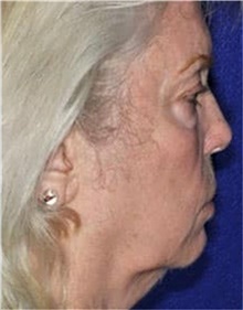 Facelift Before Photo by Ali Totonchi, MD; Cleveland, OH - Case 45643