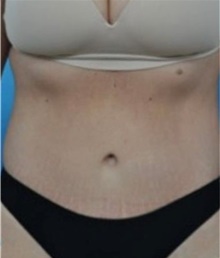 Tummy Tuck After Photo by Ali Totonchi, MD; Cleveland, OH - Case 45644