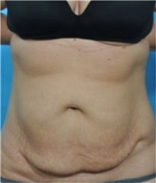 Tummy Tuck Before Photo by Ali Totonchi, MD; Cleveland, OH - Case 45644