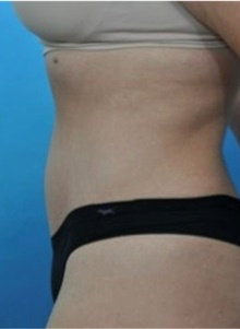 Tummy Tuck After Photo by Ali Totonchi, MD; Lyndhurst, OH - Case 45644