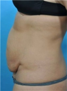 Tummy Tuck Before Photo by Ali Totonchi, MD; Lyndhurst, OH - Case 45644