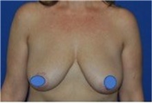 Breast Lift Before Photo by Ali Totonchi, MD; Cleveland, OH - Case 45645