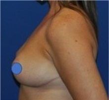 Breast Lift After Photo by Ali Totonchi, MD; Lyndhurst, OH - Case 45645