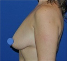 Breast Lift Before Photo by Ali Totonchi, MD; Lyndhurst, OH - Case 45645
