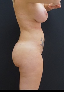 Buttock Lift with Augmentation After Photo by Johnny Franco, MD; Austin, TX - Case 39409
