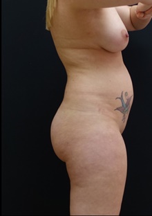 Buttock Lift with Augmentation Before Photo by Johnny Franco, MD; Austin, TX - Case 39409