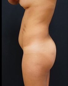 Buttock Implants Before Photo by Johnny Franco, MD; Austin, TX - Case 39410