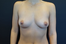 Breast Augmentation Before Photo by Johnny Franco, MD; Austin, TX - Case 39416