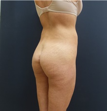 Buttock Implants Before Photo by Johnny Franco, MD; Austin, TX - Case 39723