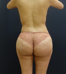 Buttock Lift with Augmentation After Photo by Johnny Franco, MD; Austin, TX - Case 39732