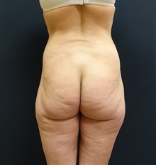 Buttock Implants Before Photo by Johnny Franco, MD; Austin, TX - Case 39742