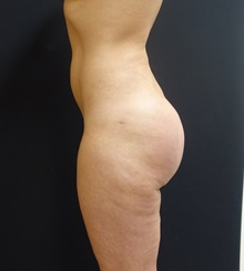 Buttock Implants After Photo by Johnny Franco, MD; Austin, TX - Case 39743