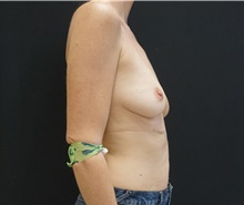 Breast Lift Before Photo by Johnny Franco, MD; Austin, TX - Case 39784