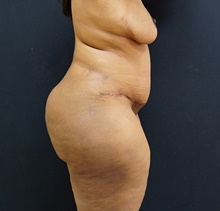 Tummy Tuck After Photo by Johnny Franco, MD; Austin, TX - Case 39796