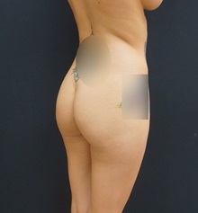 Buttock Implants Before Photo by Johnny Franco, MD; Austin, TX - Case 39851