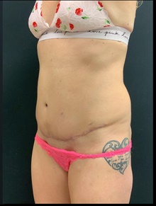 Tummy Tuck After Photo by Johnny Franco, MD; Austin, TX - Case 39855
