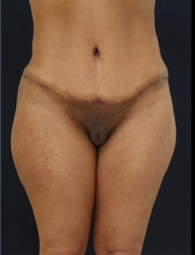 Tummy Tuck After Photo by Johnny Franco, MD; Austin, TX - Case 39916
