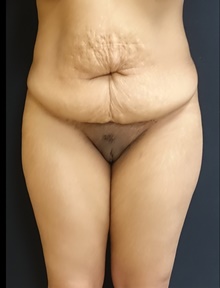 Tummy Tuck Before Photo by Johnny Franco, MD; Austin, TX - Case 39916