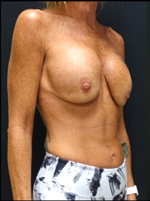Breast Implant Revision Before Photo by Johnny Franco, MD; Austin, TX - Case 39920