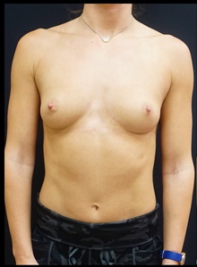 Breast Augmentation Before Photo by Johnny Franco, MD; Austin, TX - Case 39930