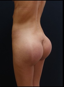 Buttock Implants After Photo by Johnny Franco, MD; Austin, TX - Case 39939