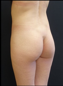 Buttock Implants Before Photo by Johnny Franco, MD; Austin, TX - Case 39939