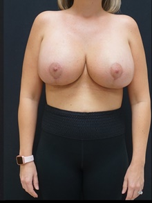 Breast Lift After Photo by Johnny Franco, MD; Austin, TX - Case 39940