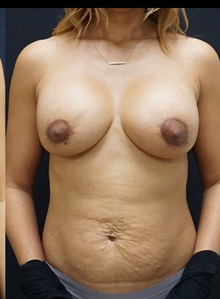 Breast Implant Revision After Photo by Johnny Franco, MD; Austin, TX - Case 39955