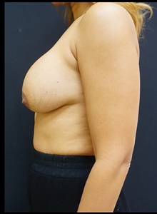 Breast Implant Revision Before Photo by Johnny Franco, MD; Austin, TX - Case 39956
