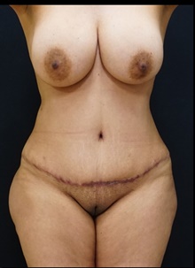 Tummy Tuck After Photo by Johnny Franco, MD; Austin, TX - Case 39988