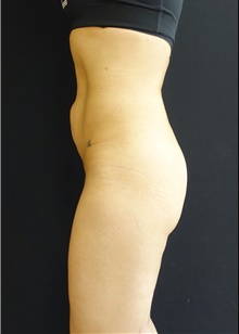 Buttock Implants Before Photo by Johnny Franco, MD; Austin, TX - Case 44126