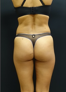 Buttock Implants Before Photo by Johnny Franco, MD; Austin, TX - Case 44131