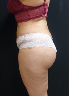 Buttock Implants After Photo by Johnny Franco, MD; Austin, TX - Case 44132
