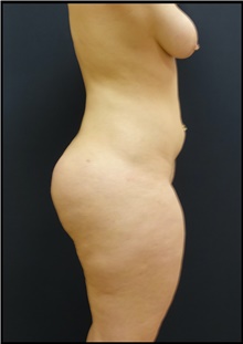 Buttock Lift with Augmentation After Photo by Johnny Franco, MD; Austin, TX - Case 44287